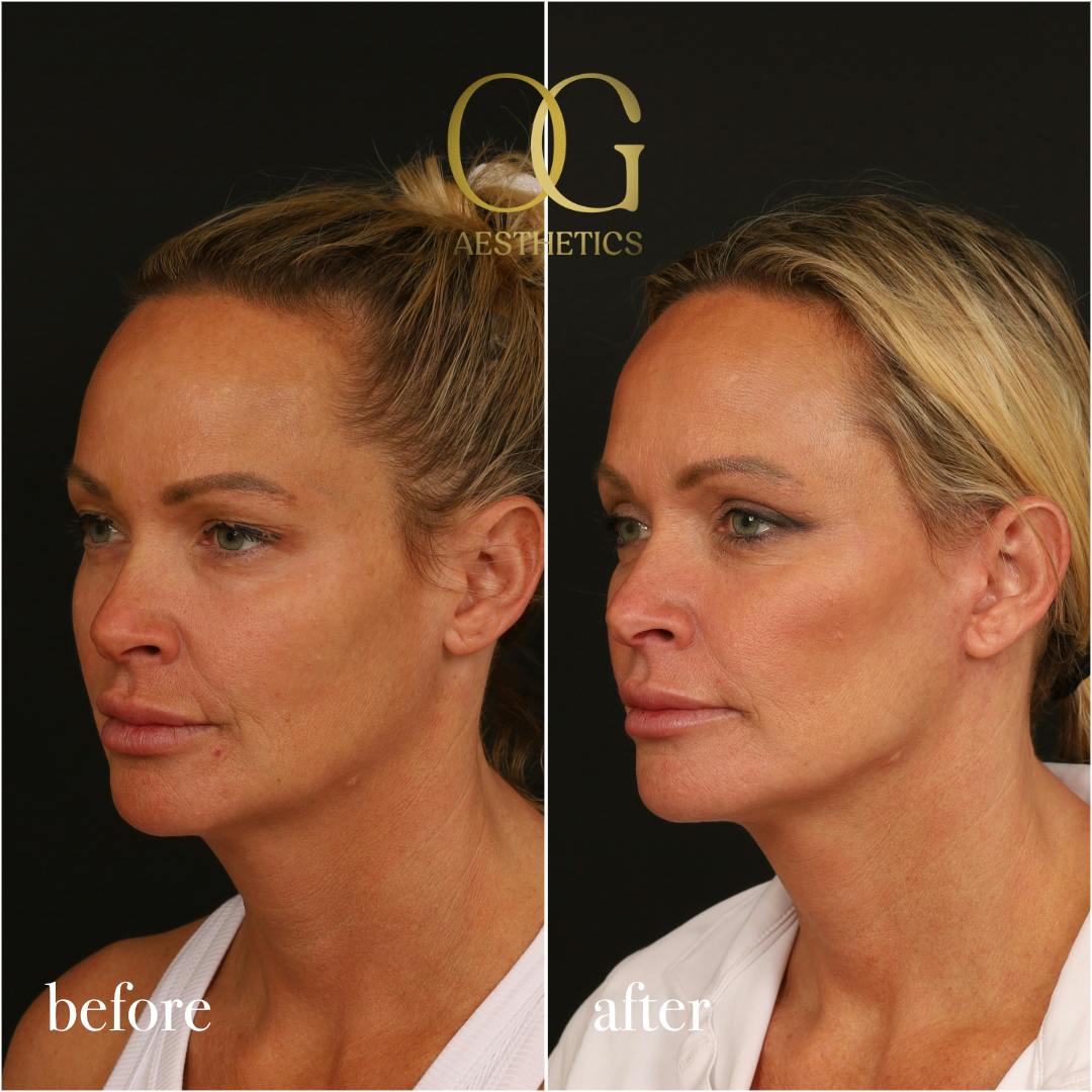 Blepharoplasty Before & After Gallery - Patient 242962 - Image 7