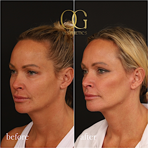 Blepharoplasty Before & After Gallery - Patient 242962 - Image 7