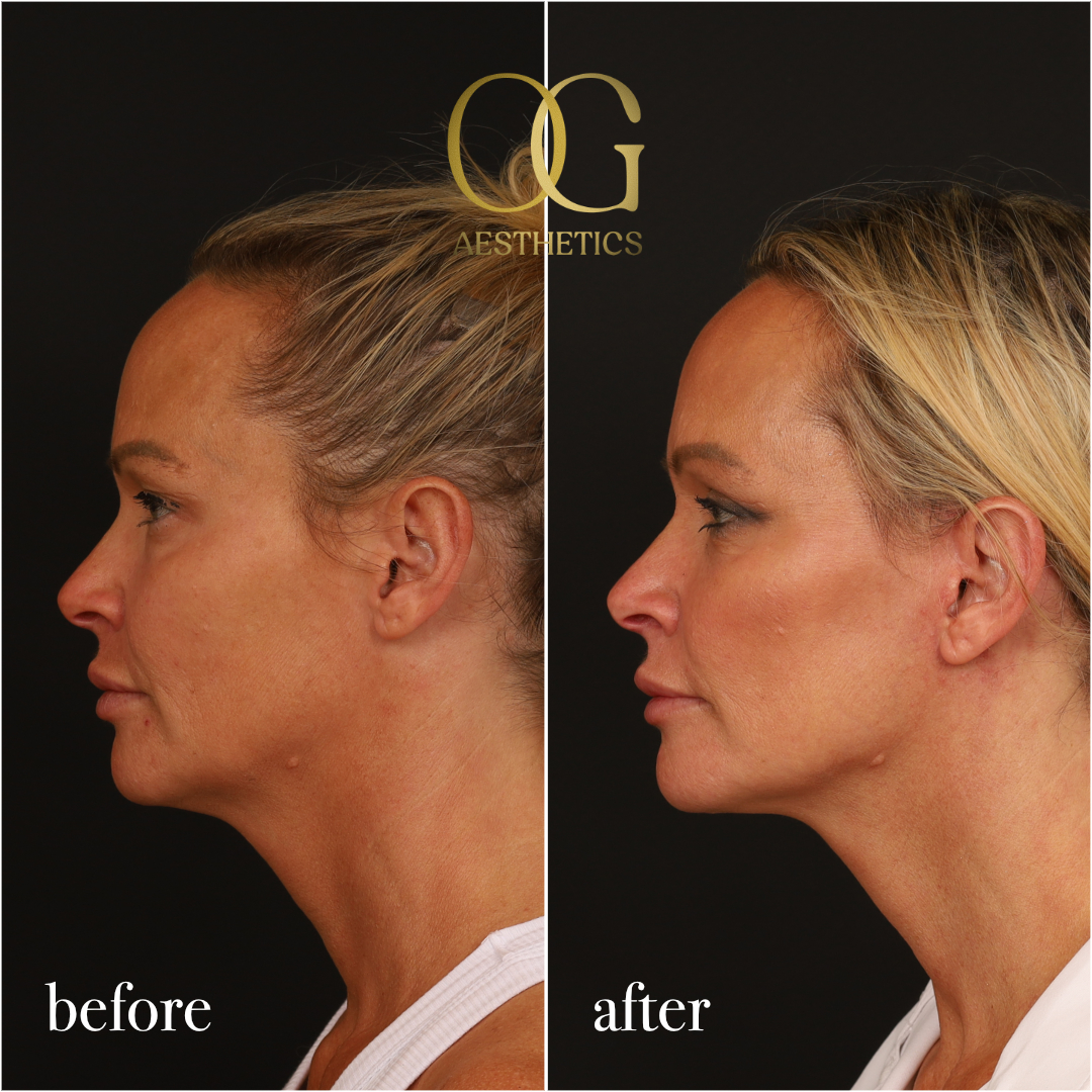 Blepharoplasty Before & After Gallery - Patient 242962 - Image 8