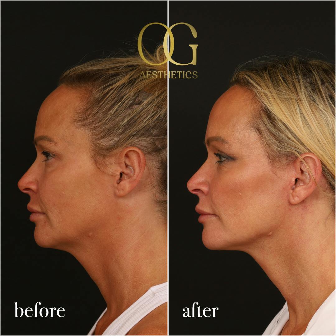 Blepharoplasty Before & After Gallery - Patient 242962 - Image 8