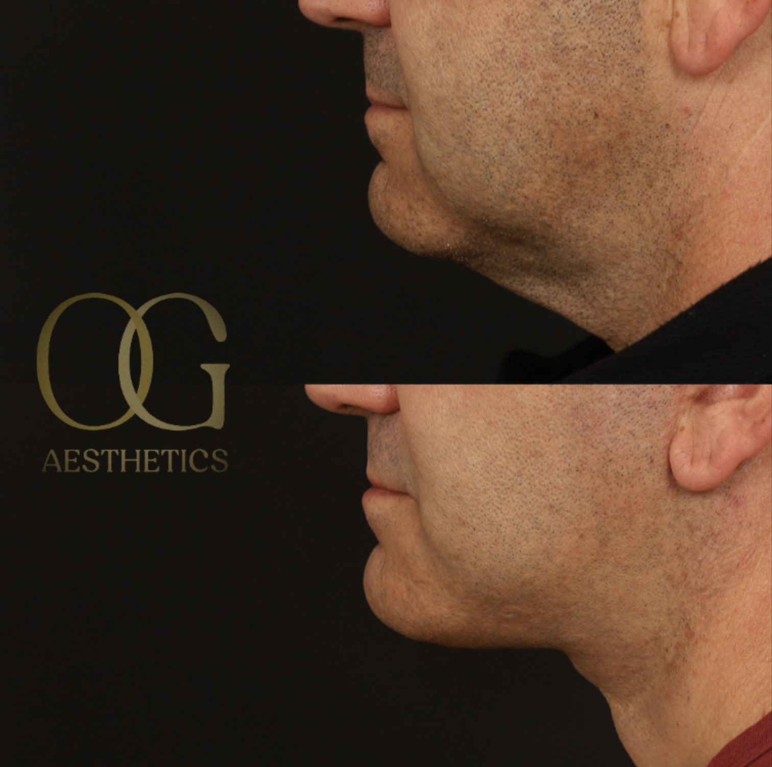 Neck Lift Before & After Gallery - Patient 184651 - Image 5