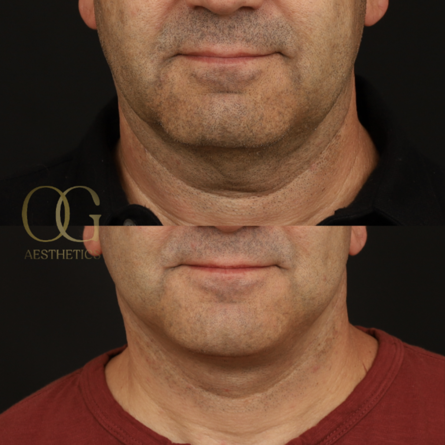 Neck Lift Before & After Gallery - Patient 184651 - Image 1