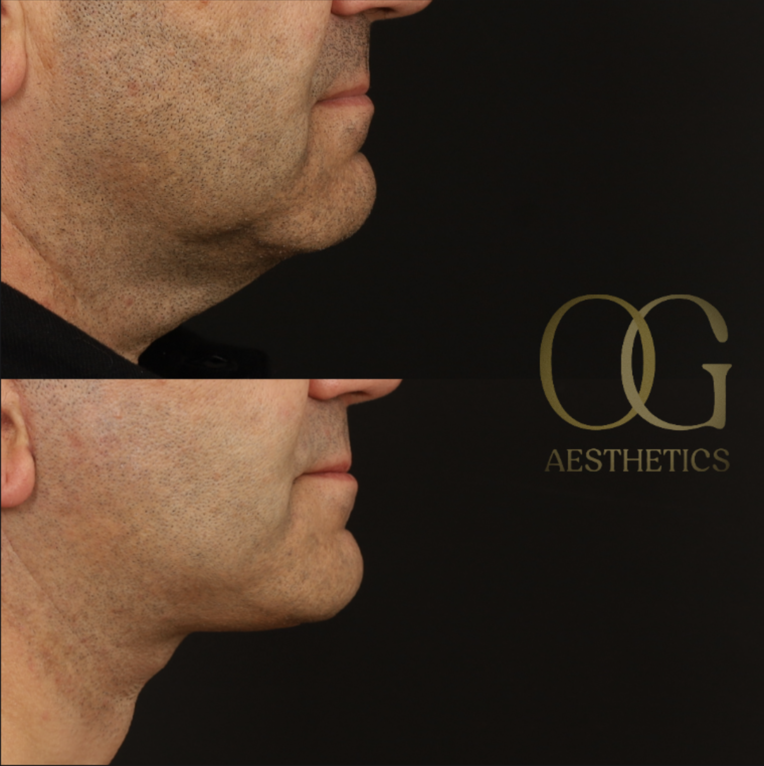 Neck Lift Before & After Gallery - Patient 184651 - Image 3