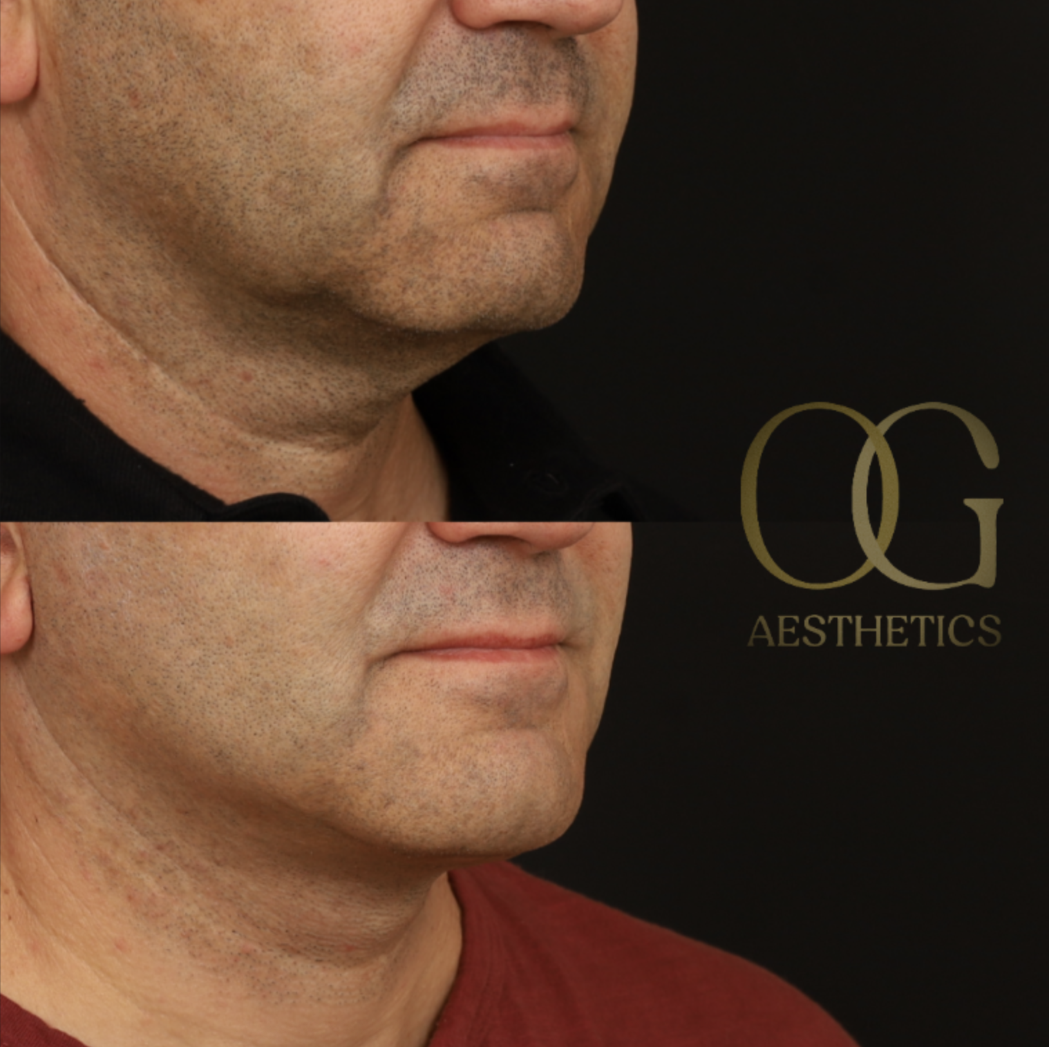 Neck Lift Before & After Gallery - Patient 184651 - Image 2