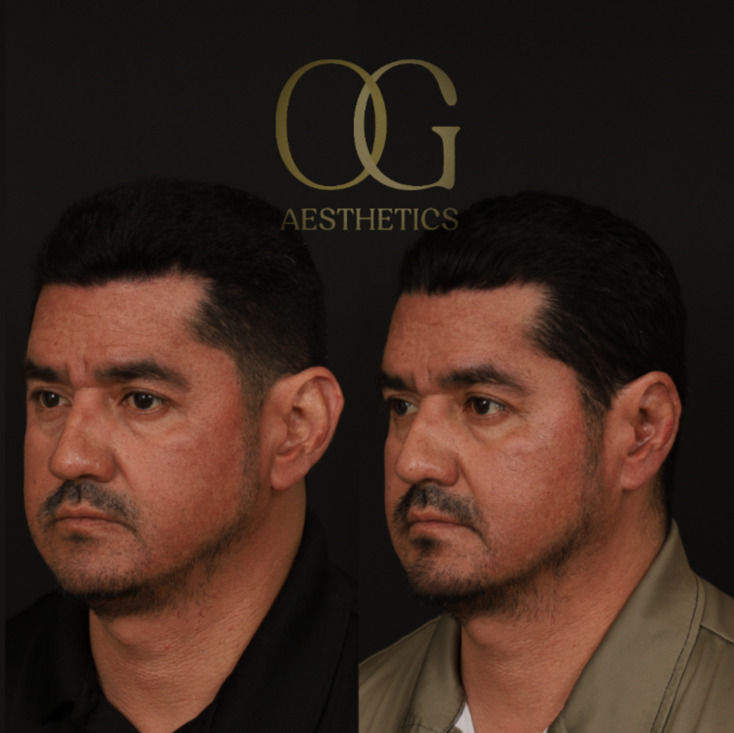 Otoplasty Before & After Gallery - Patient 475124 - Image 4