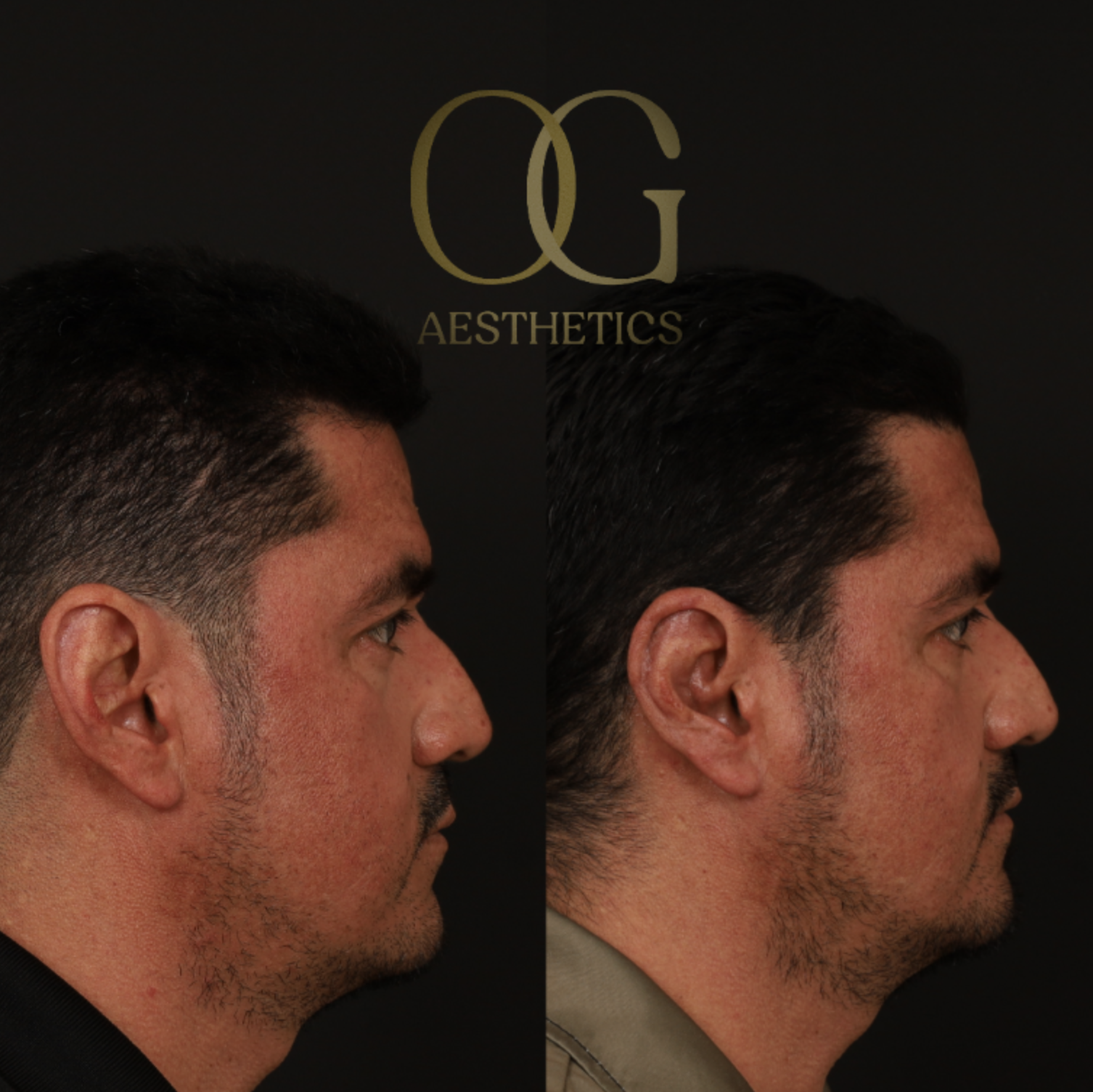 Otoplasty Before & After Gallery - Patient 475124 - Image 3