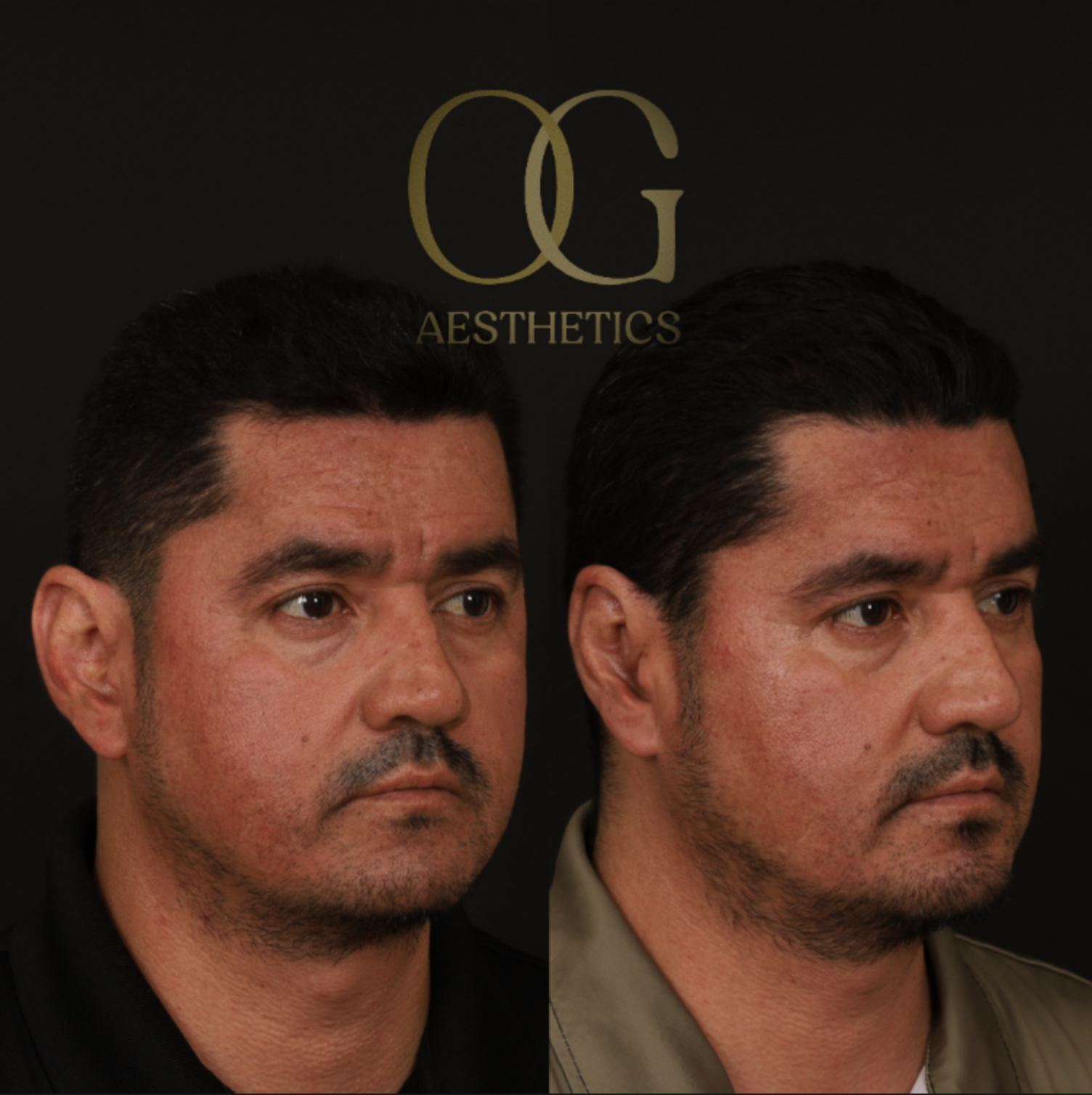 Otoplasty Before & After Gallery - Patient 475124 - Image 2