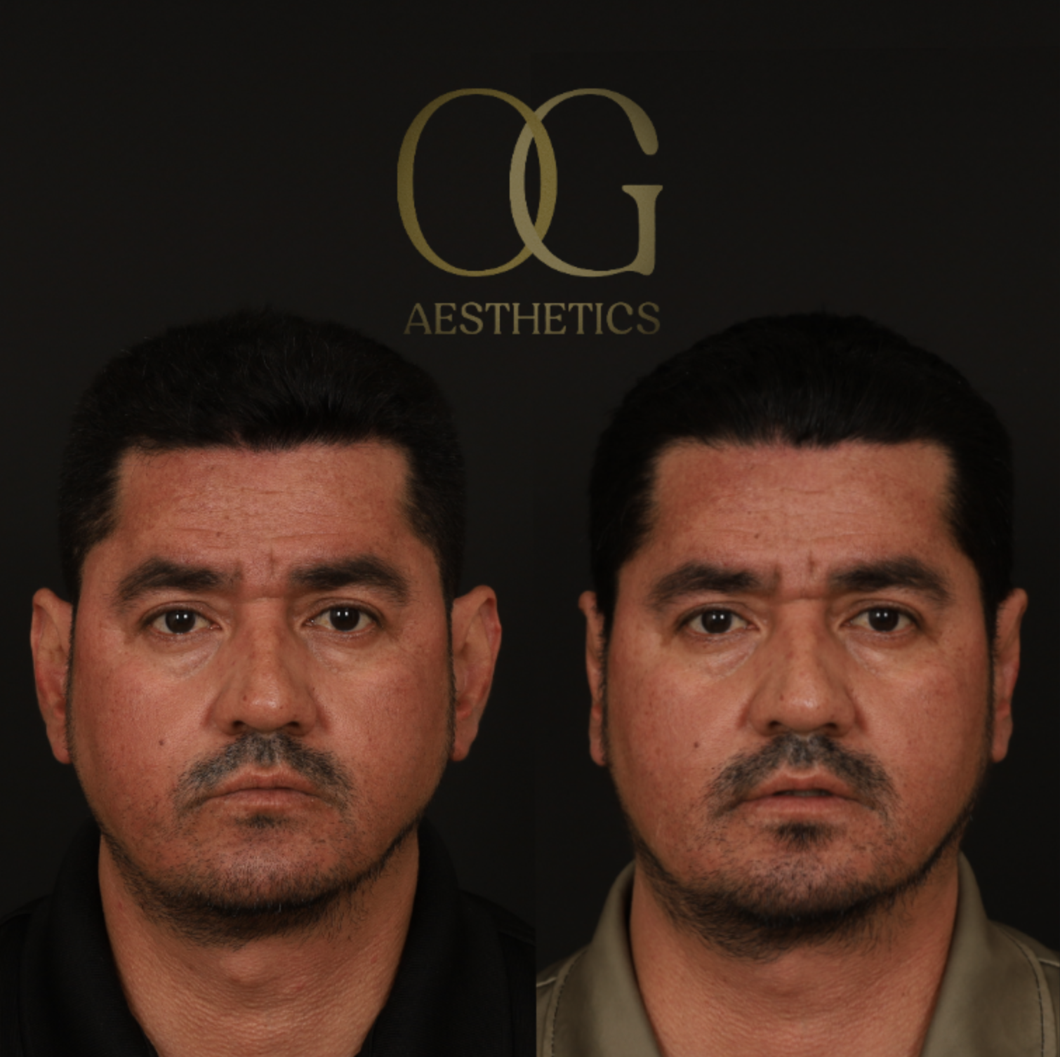 Otoplasty Before & After Gallery - Patient 475124 - Image 1
