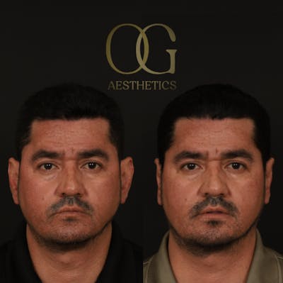 Otoplasty Before & After Gallery - Patient 475124 - Image 1