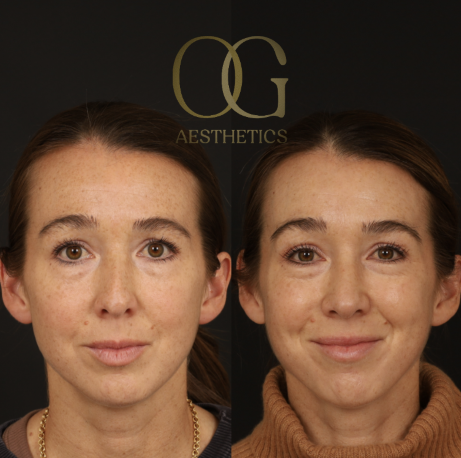 Revision Rhinoplasty Before & After Gallery - Patient 381008 - Image 3