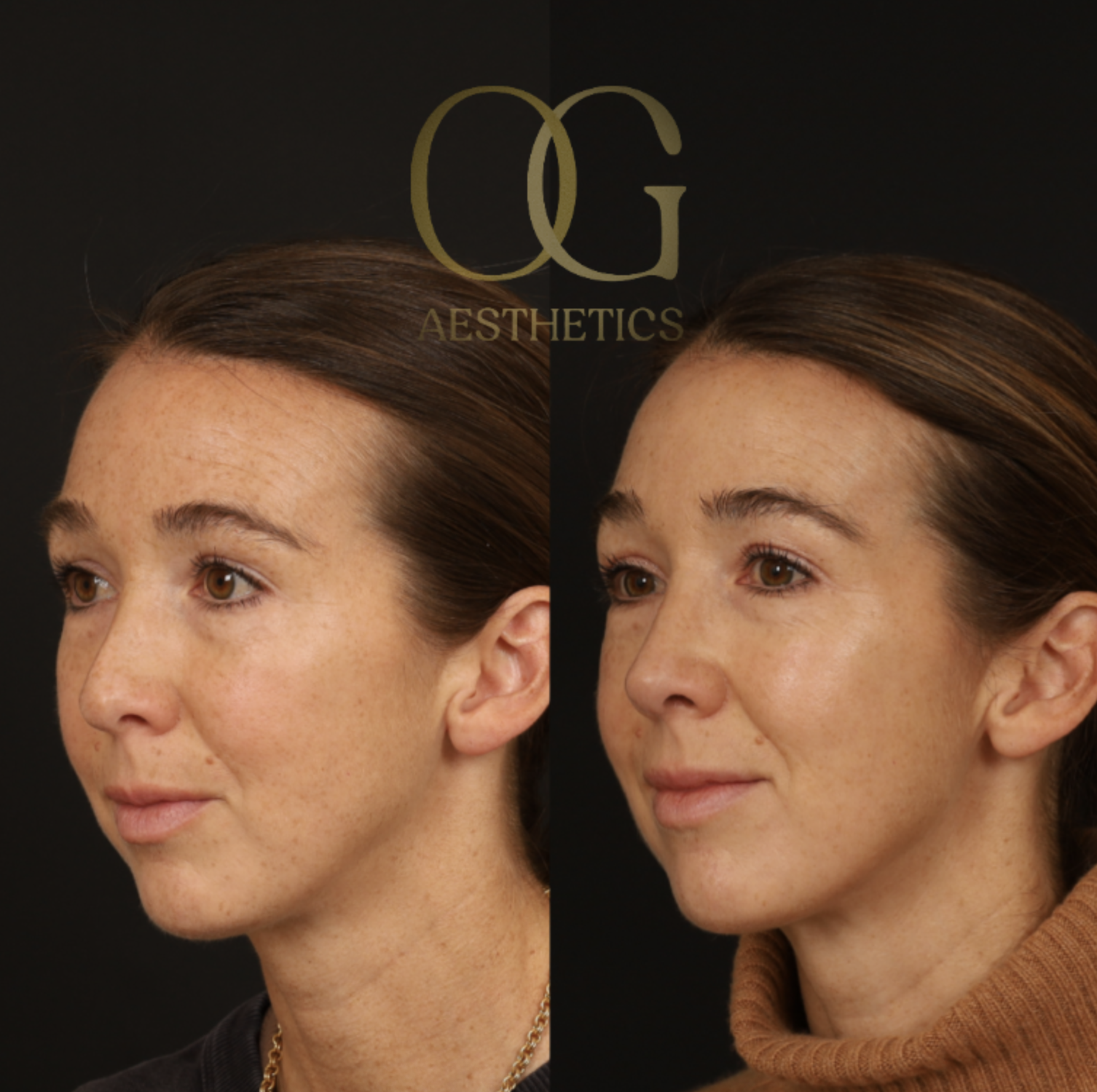 Revision Rhinoplasty Before & After Gallery - Patient 381008 - Image 4
