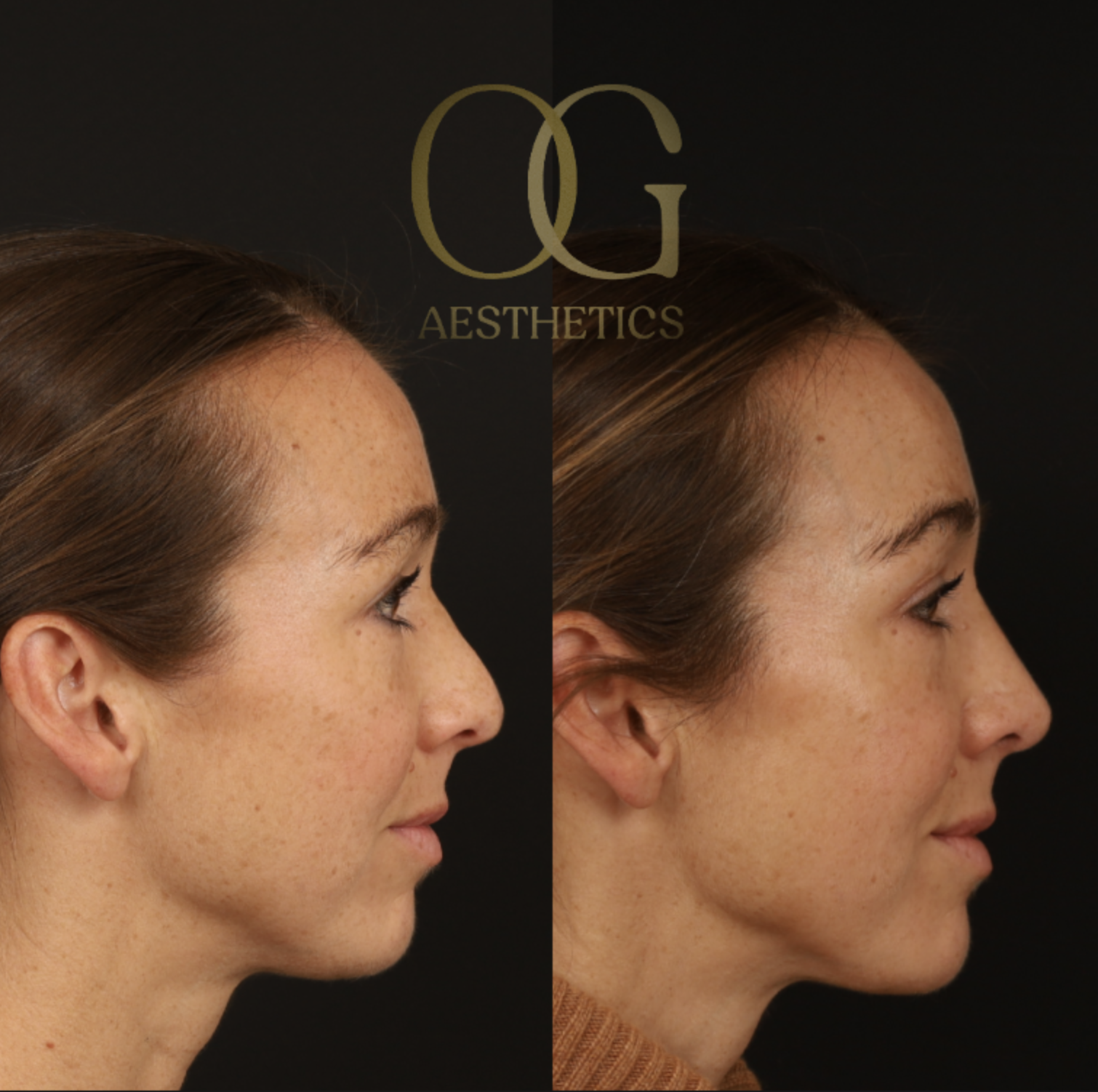 Revision Rhinoplasty Before & After Gallery - Patient 381008 - Image 1