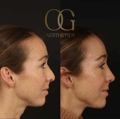 Revision Rhinoplasty Before & After Gallery - Patient 381008 - Image 1