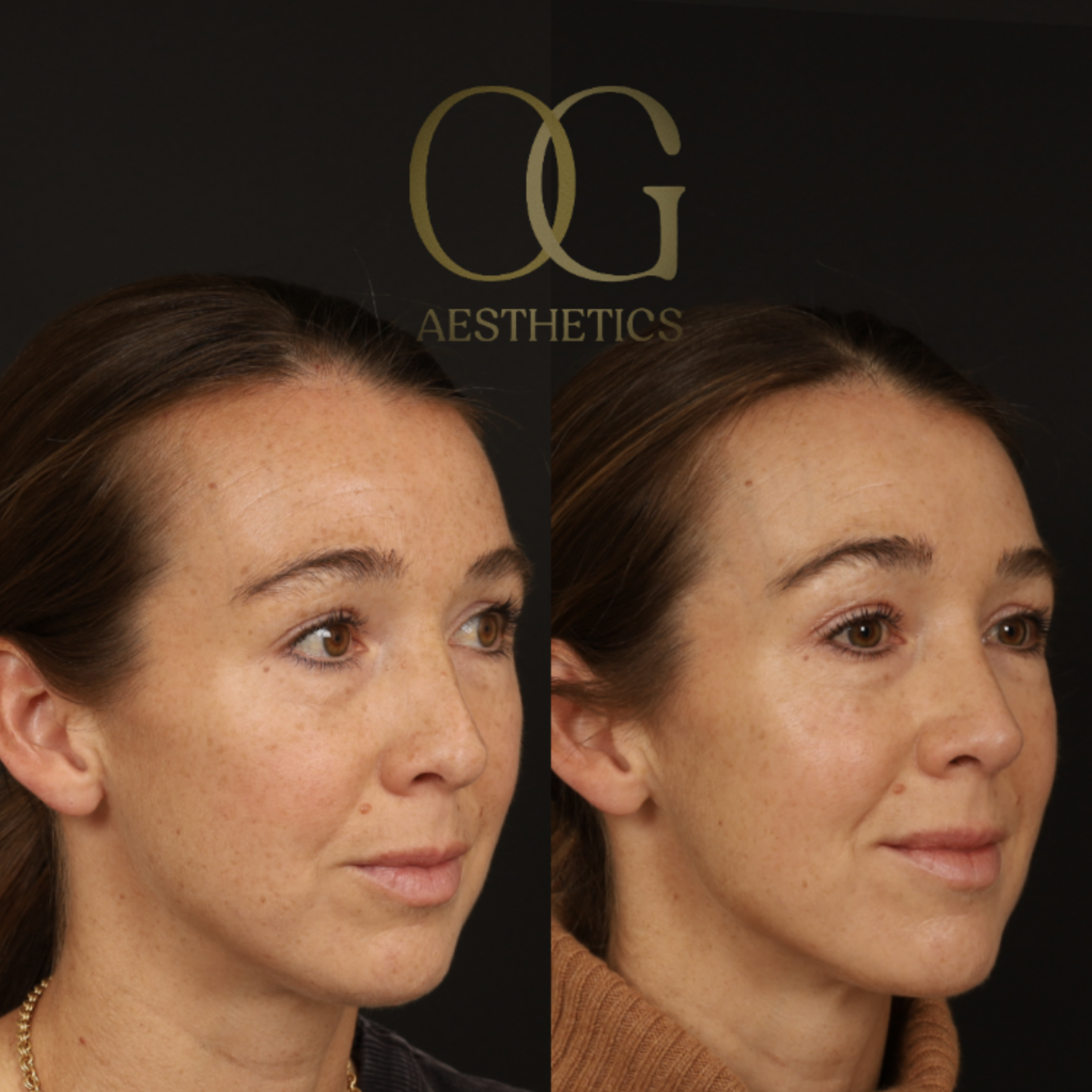 Revision Rhinoplasty Before & After Gallery - Patient 381008 - Image 2