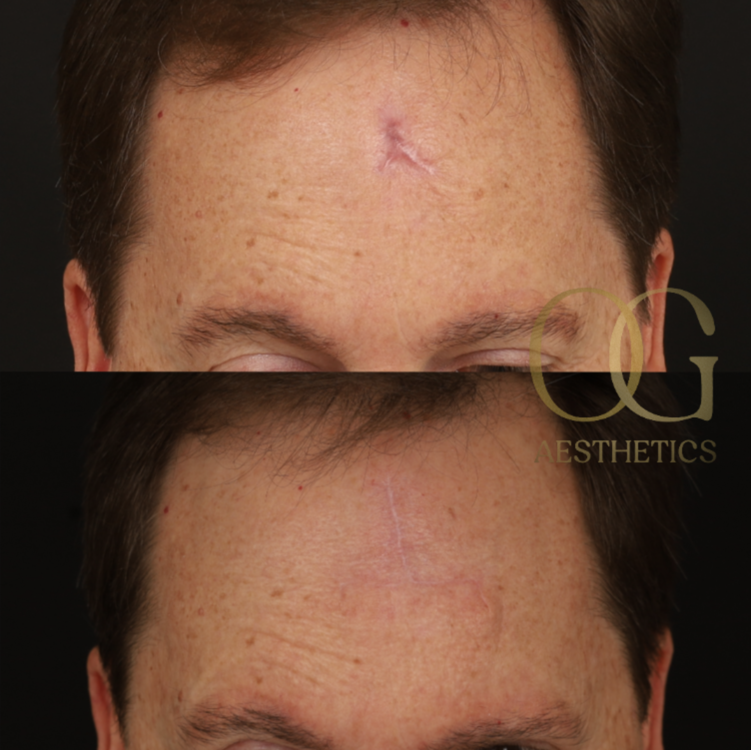 Scar Revision Before & After Gallery - Patient 416780 - Image 1
