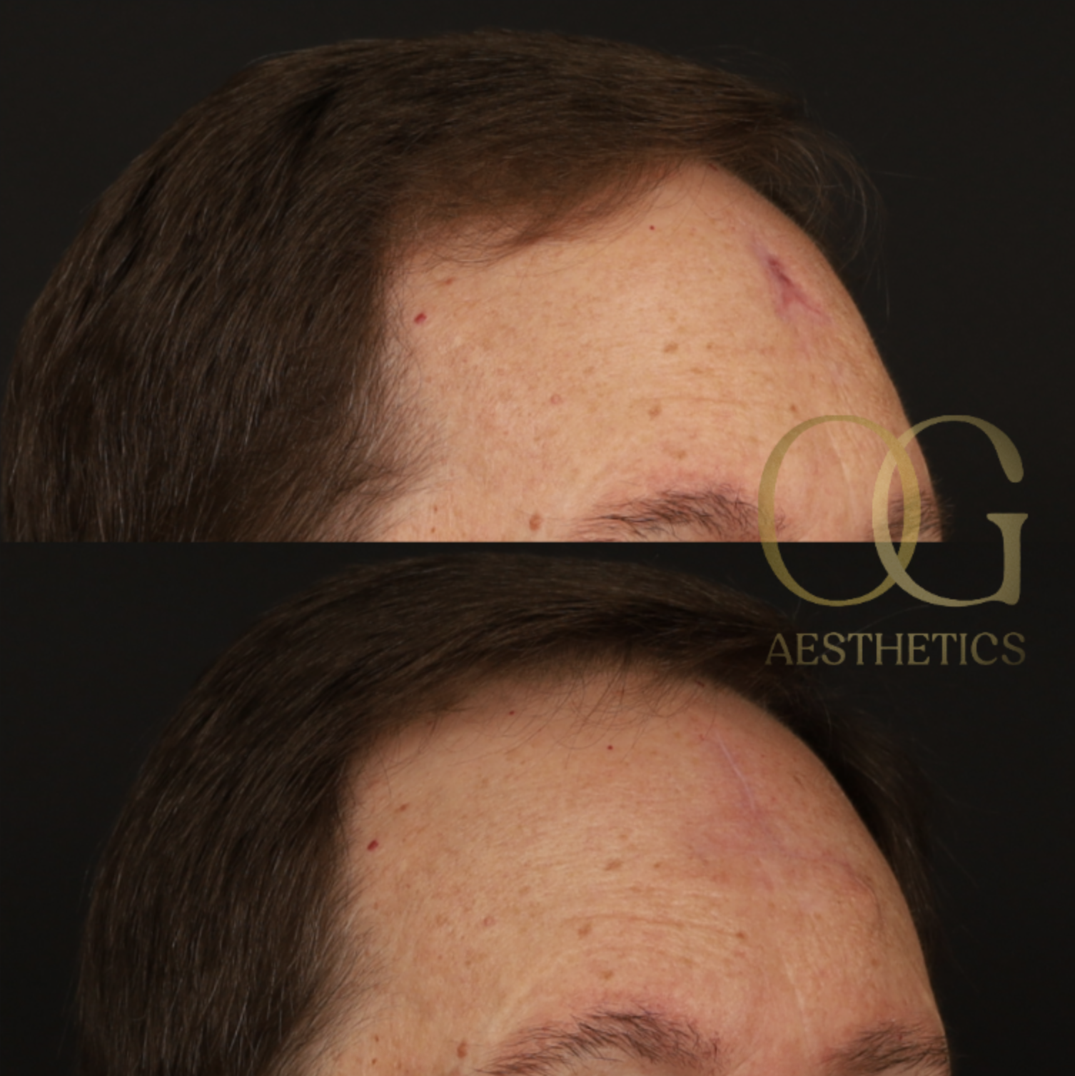 Scar Revision Before & After Gallery - Patient 416780 - Image 3