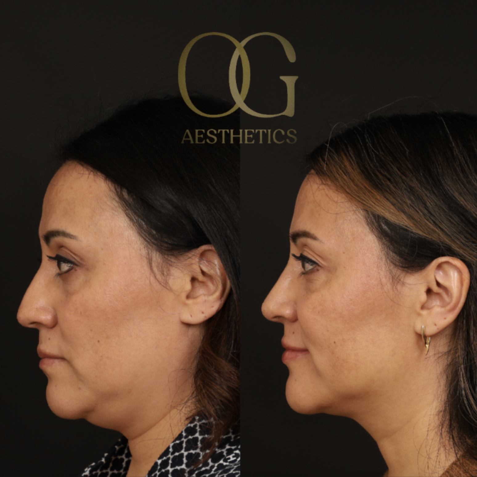 Rhinoplasty Before & After Gallery - Patient 331417 - Image 4