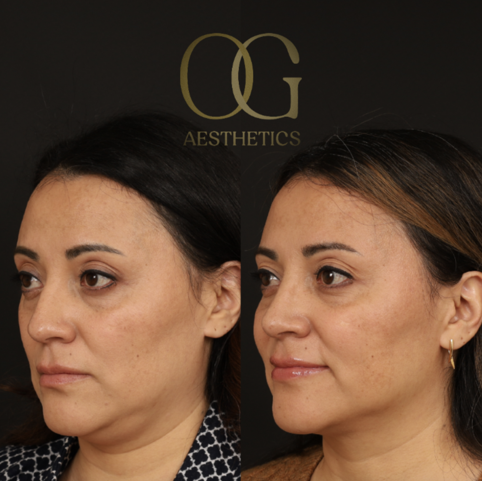 Rhinoplasty Before & After Gallery - Patient 331417 - Image 5