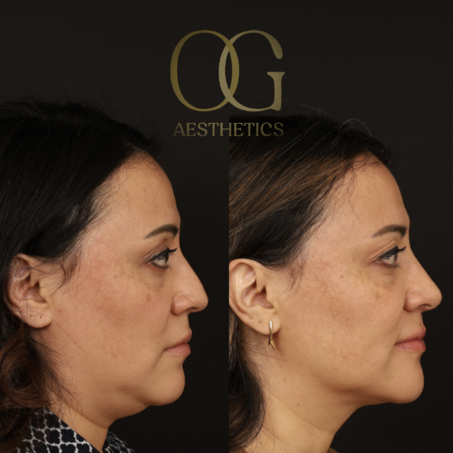 Rhinoplasty Before & After Gallery - Patient 331417 - Image 1