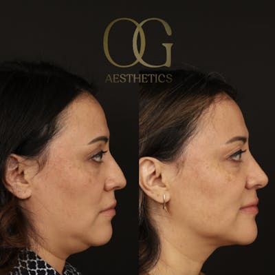 Rhinoplasty Before & After Gallery - Patient 331417 - Image 1