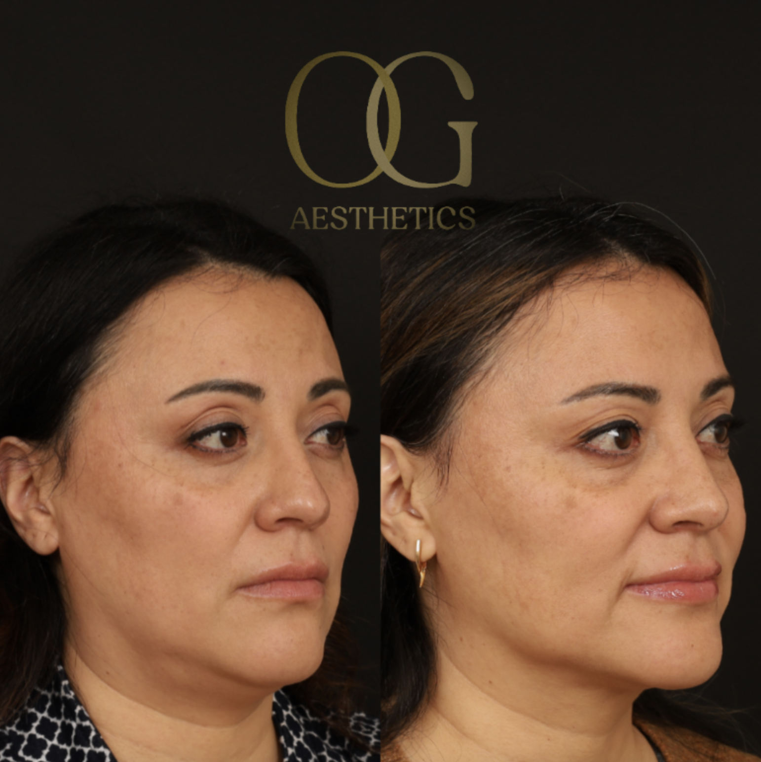 Rhinoplasty Before & After Gallery - Patient 331417 - Image 2