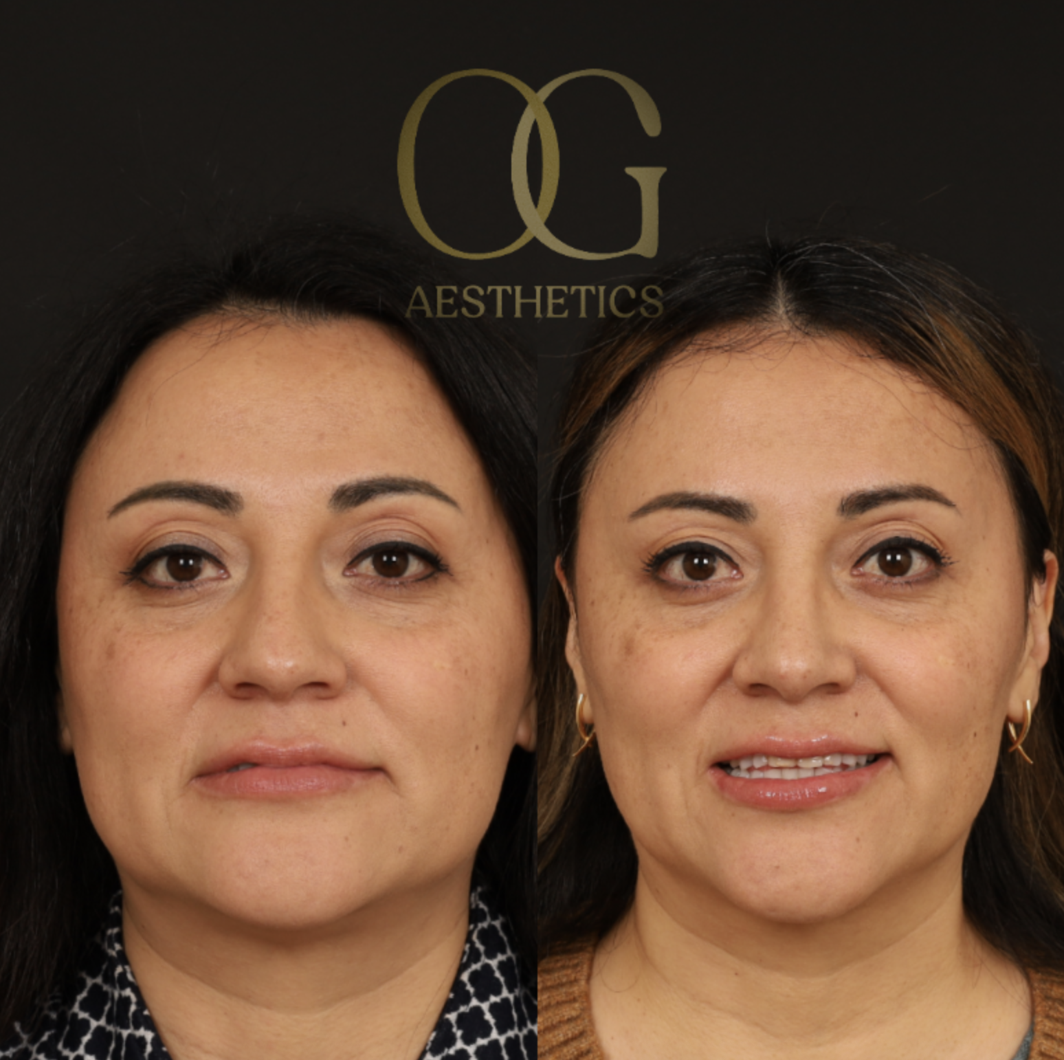 Rhinoplasty Before & After Gallery - Patient 331417 - Image 3