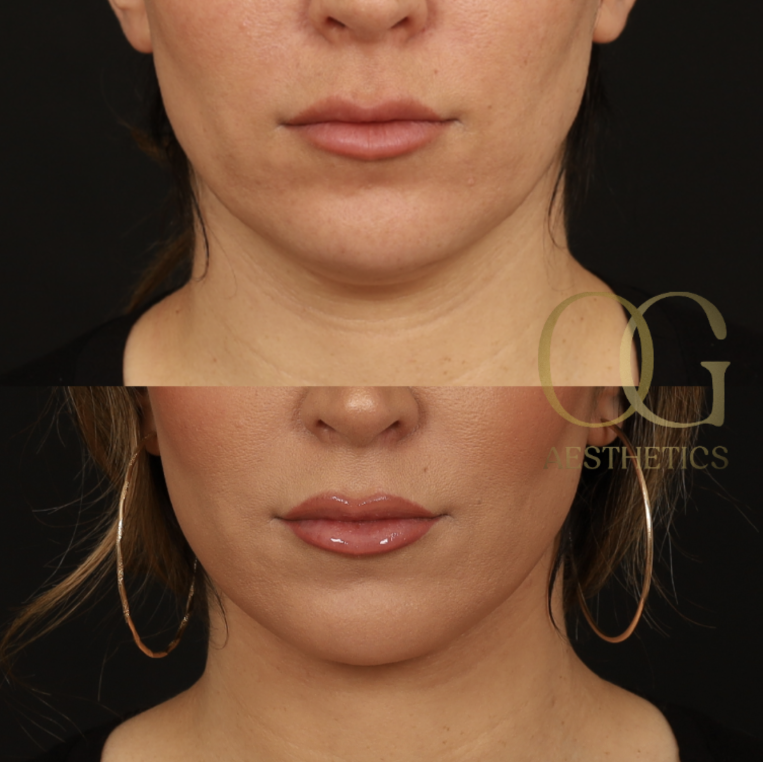 Neck Lift Before & After Gallery - Patient 168737 - Image 1