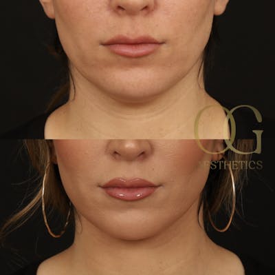 Neck Lift Before & After Gallery - Patient 168737 - Image 1
