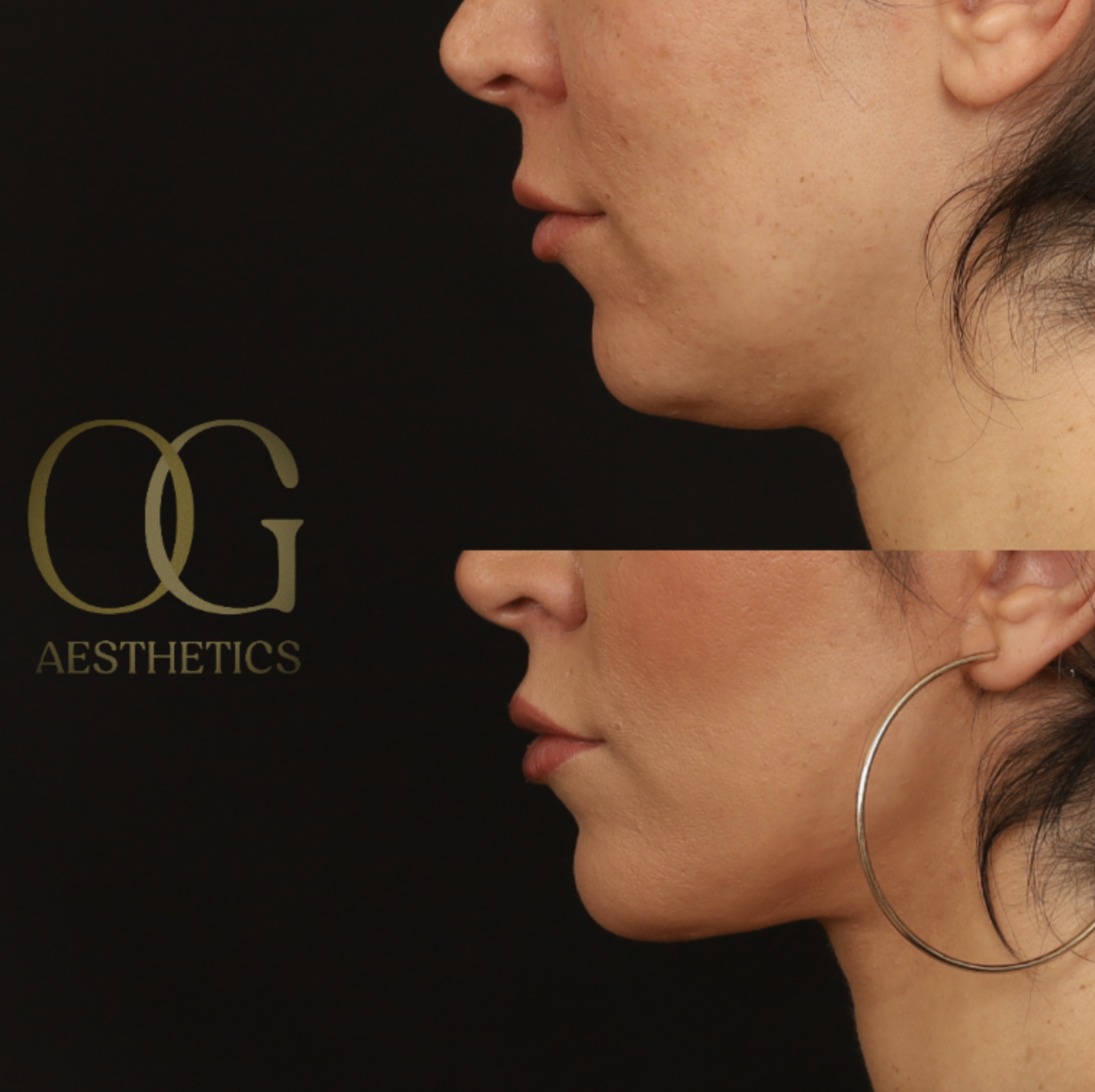 Neck Lift Before & After Gallery - Patient 168737 - Image 6