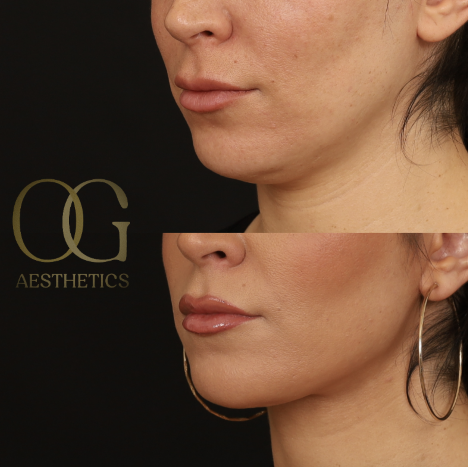 Neck Lift Before & After Gallery - Patient 168737 - Image 5
