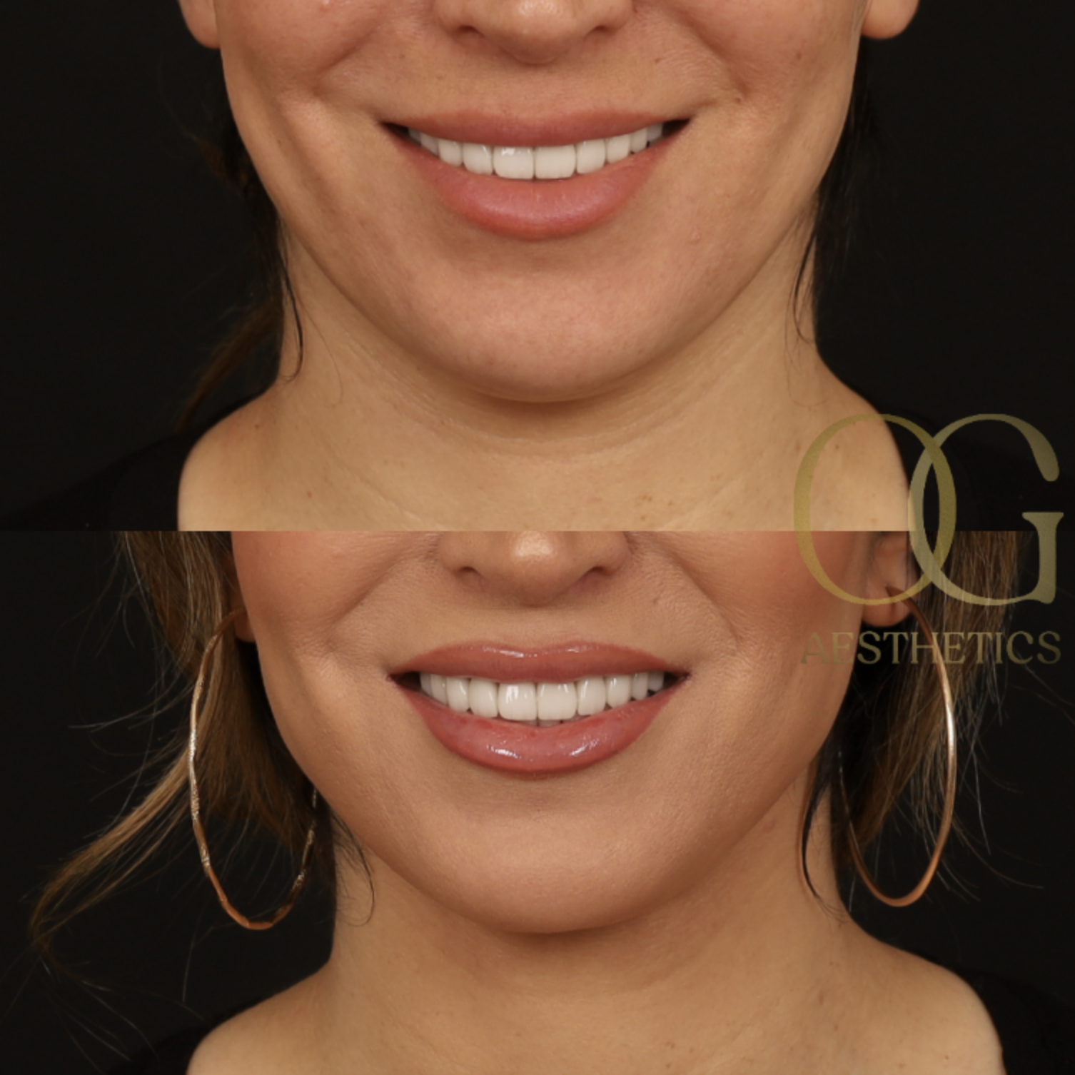 Neck Lift Before & After Gallery - Patient 168737 - Image 2