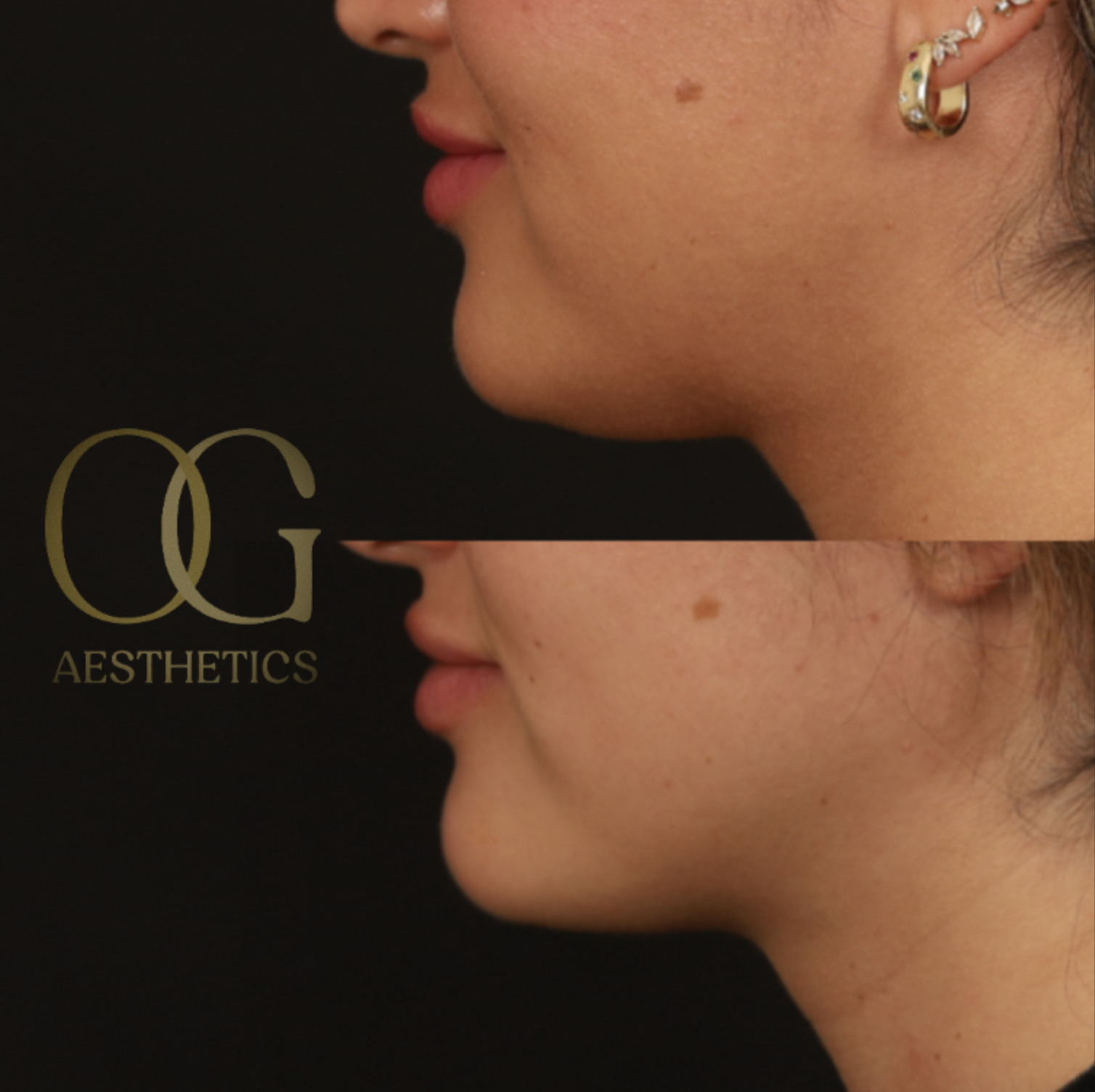 Submental Liposuction Before & After Gallery - Patient 204745 - Image 4
