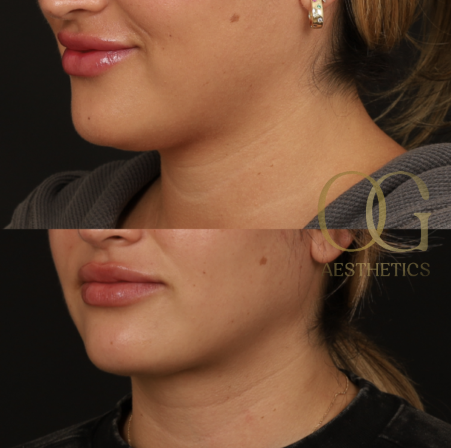 Submental Liposuction Before & After Gallery - Patient 204745 - Image 3
