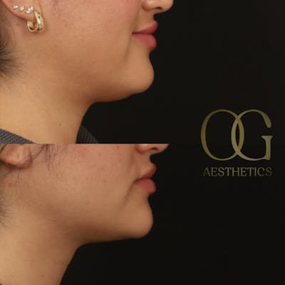 Submental Liposuction Before & After Gallery - Patient 204745 - Image 1