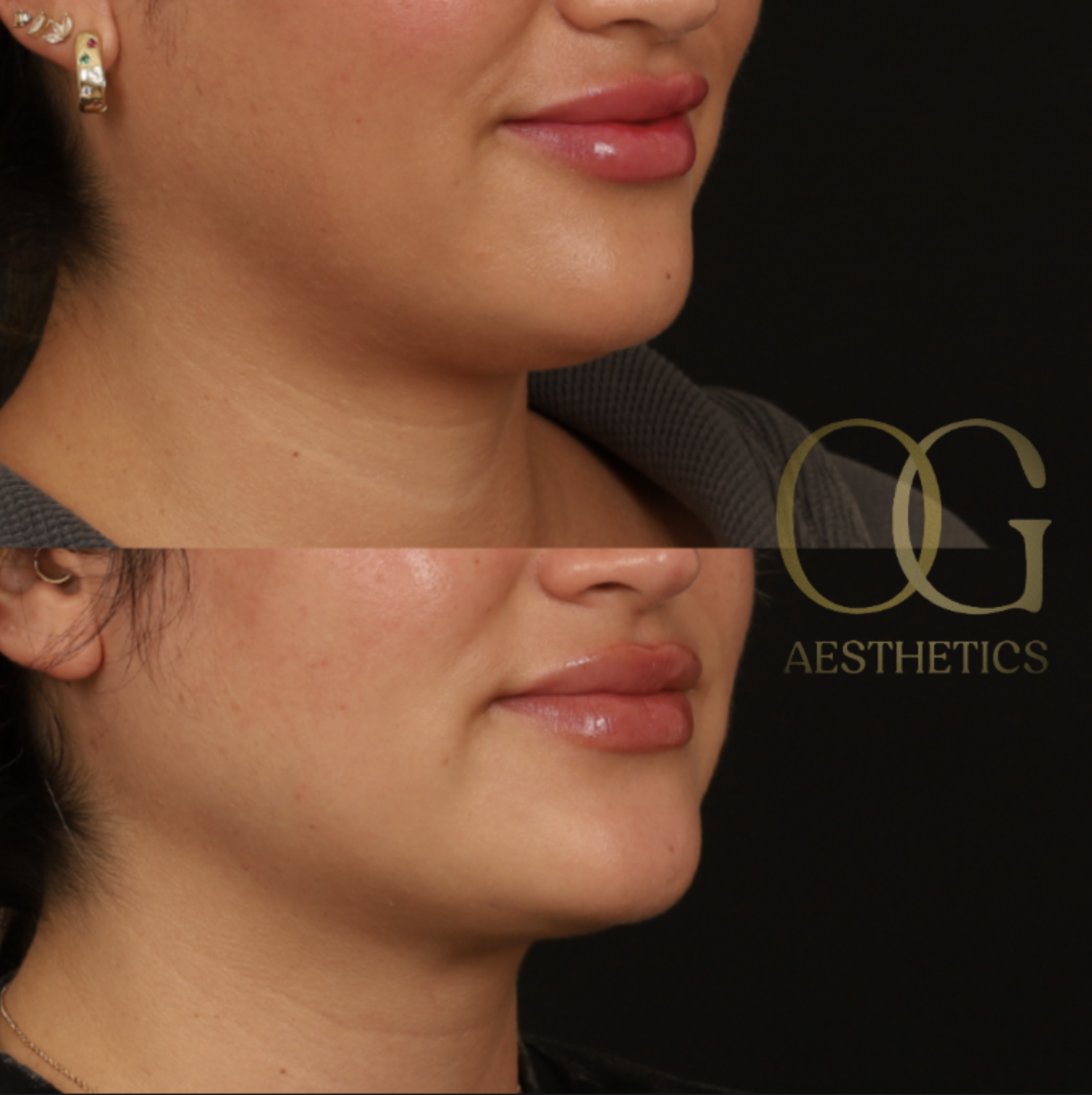 Submental Liposuction Before & After Gallery - Patient 204745 - Image 2
