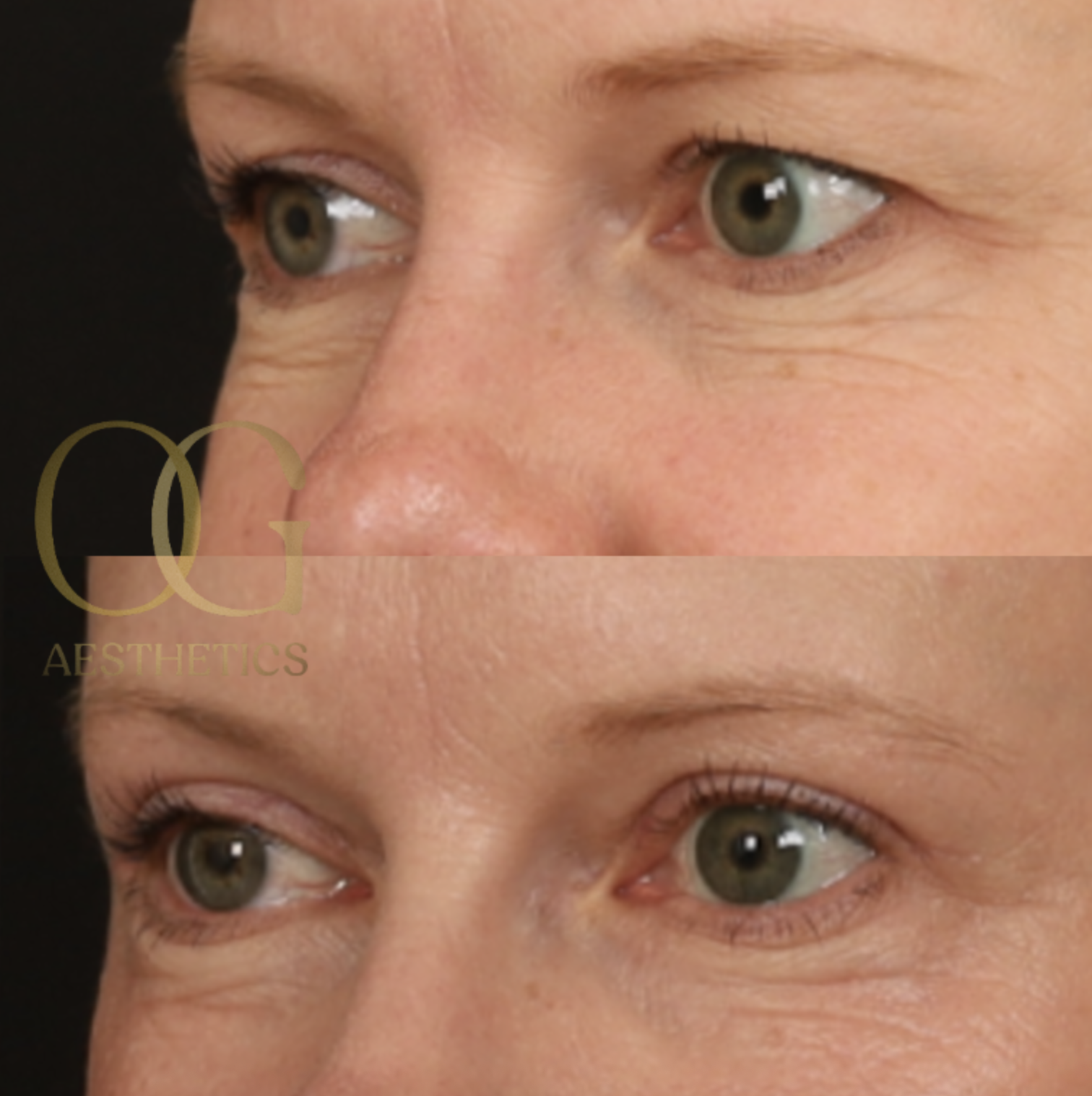 Blepharoplasty Before & After Gallery - Patient 479322 - Image 4
