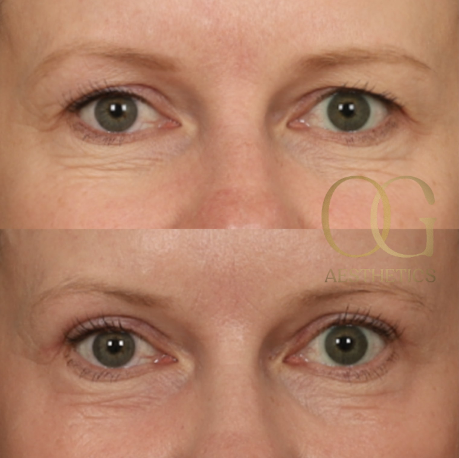 Blepharoplasty Before & After Gallery - Patient 479322 - Image 1