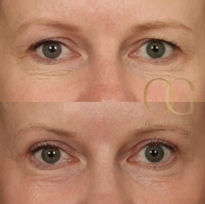 Blepharoplasty Before & After Gallery - Patient 479322 - Image 1