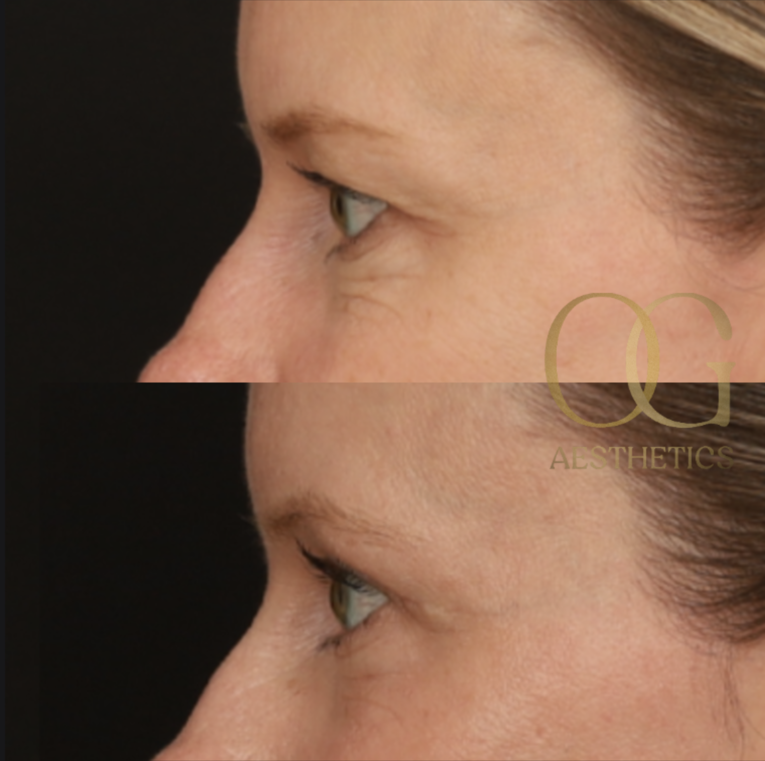 Blepharoplasty Before & After Gallery - Patient 479322 - Image 5