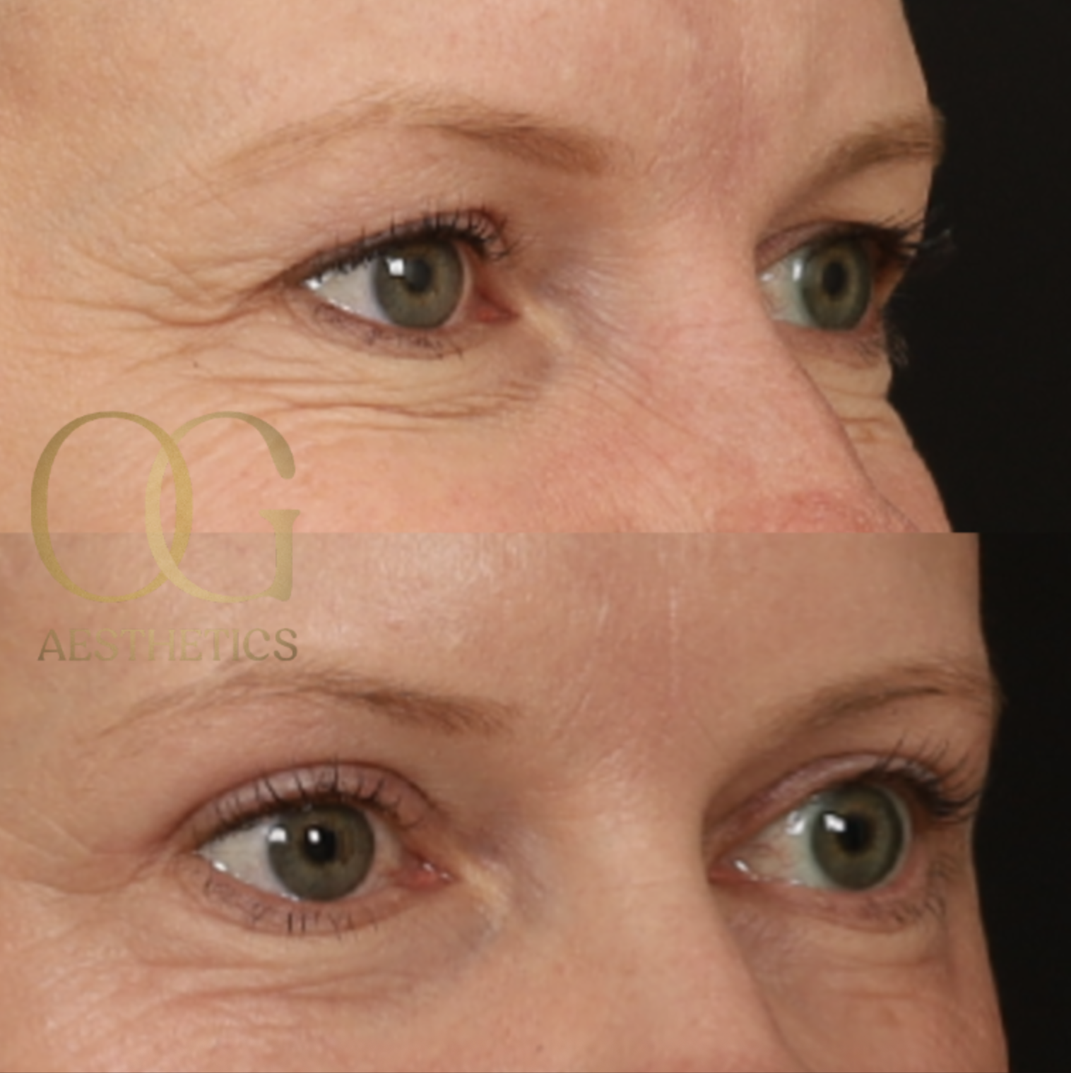 Blepharoplasty Before & After Gallery - Patient 479322 - Image 2