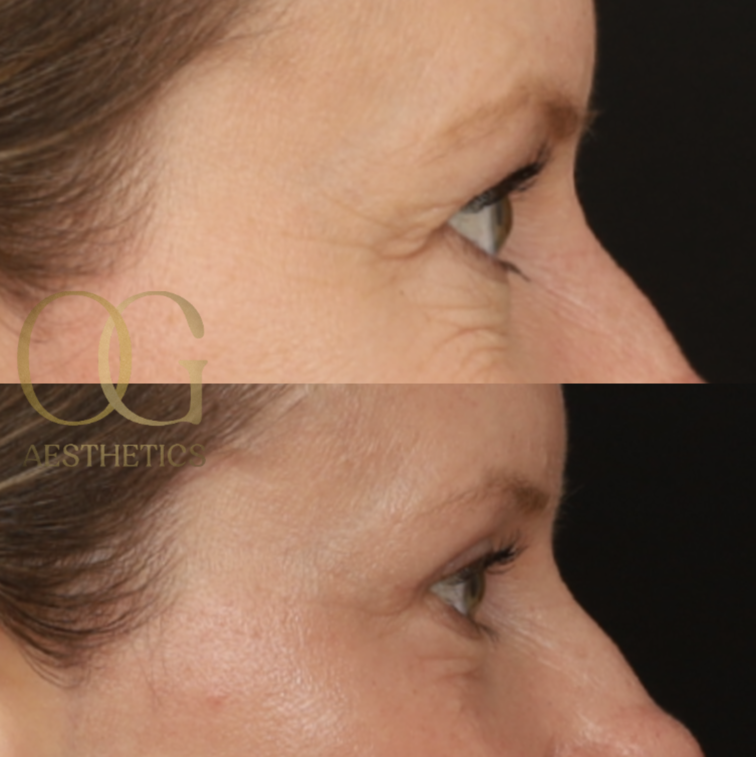 Blepharoplasty Before & After Gallery - Patient 479322 - Image 3
