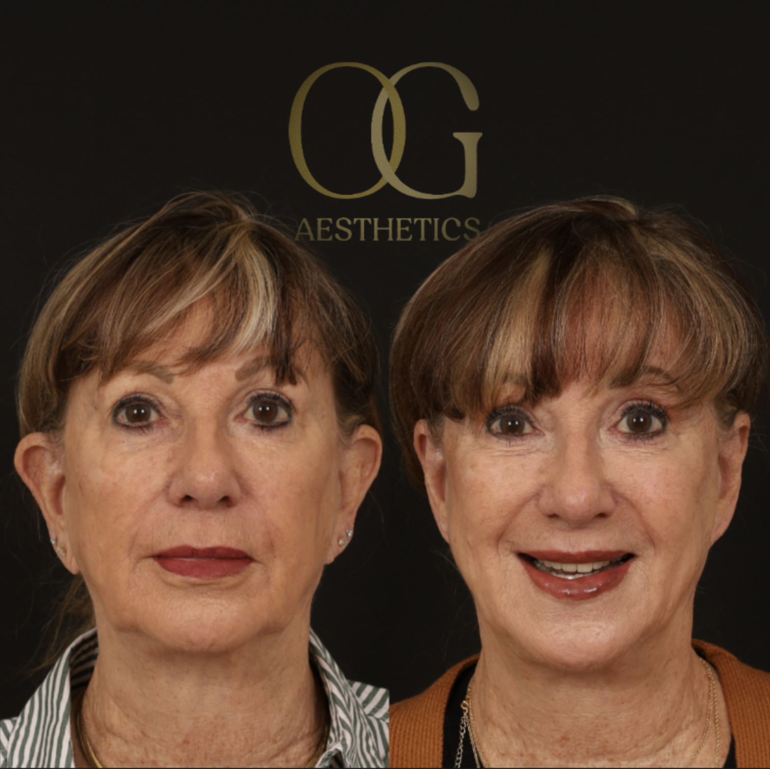 Otoplasty Before & After Gallery - Patient 319482 - Image 1