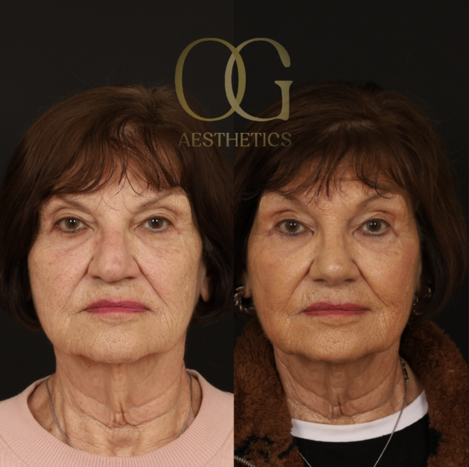 Rhinoplasty Before & After Gallery - Patient 882611 - Image 5