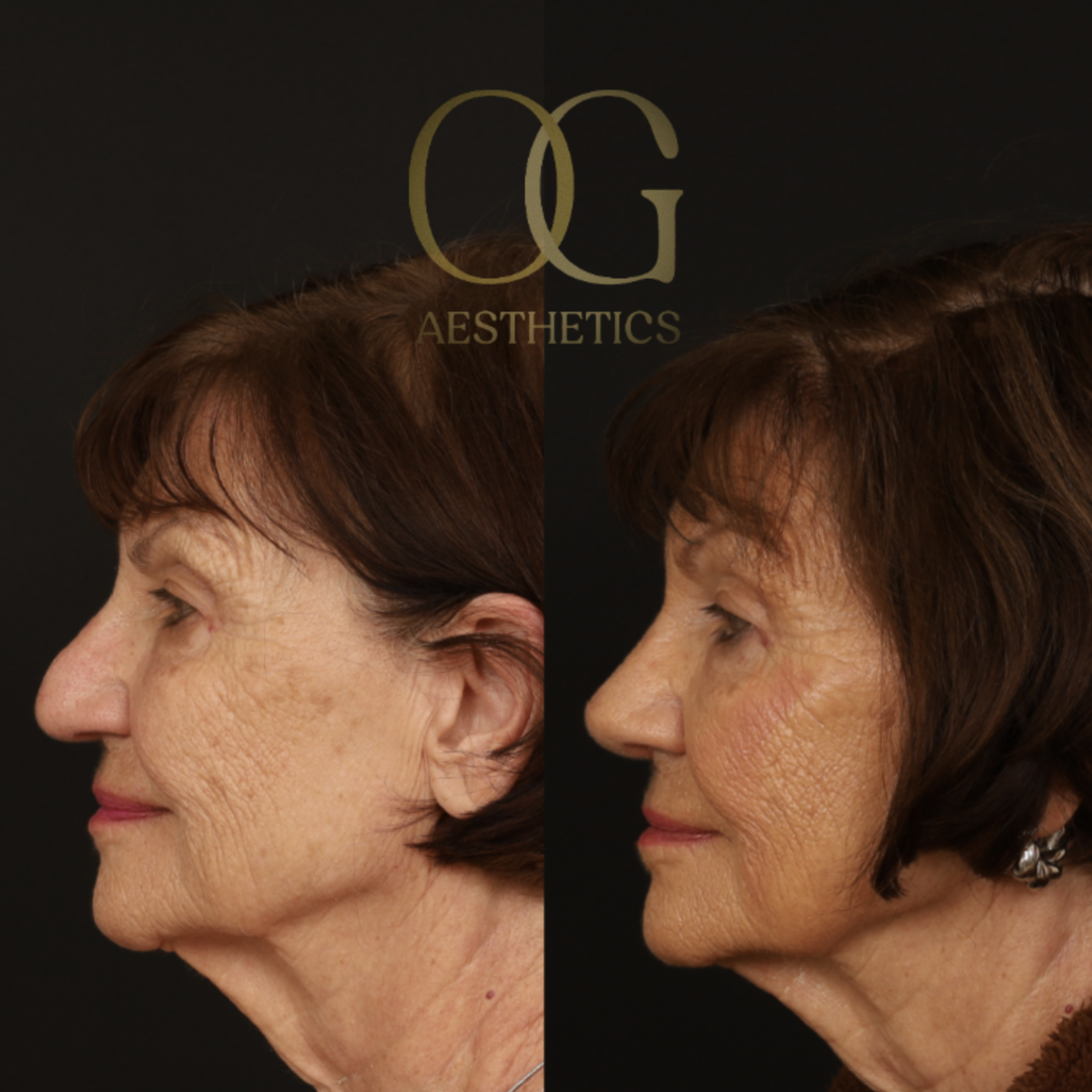 Rhinoplasty Before & After Gallery - Patient 882611 - Image 3
