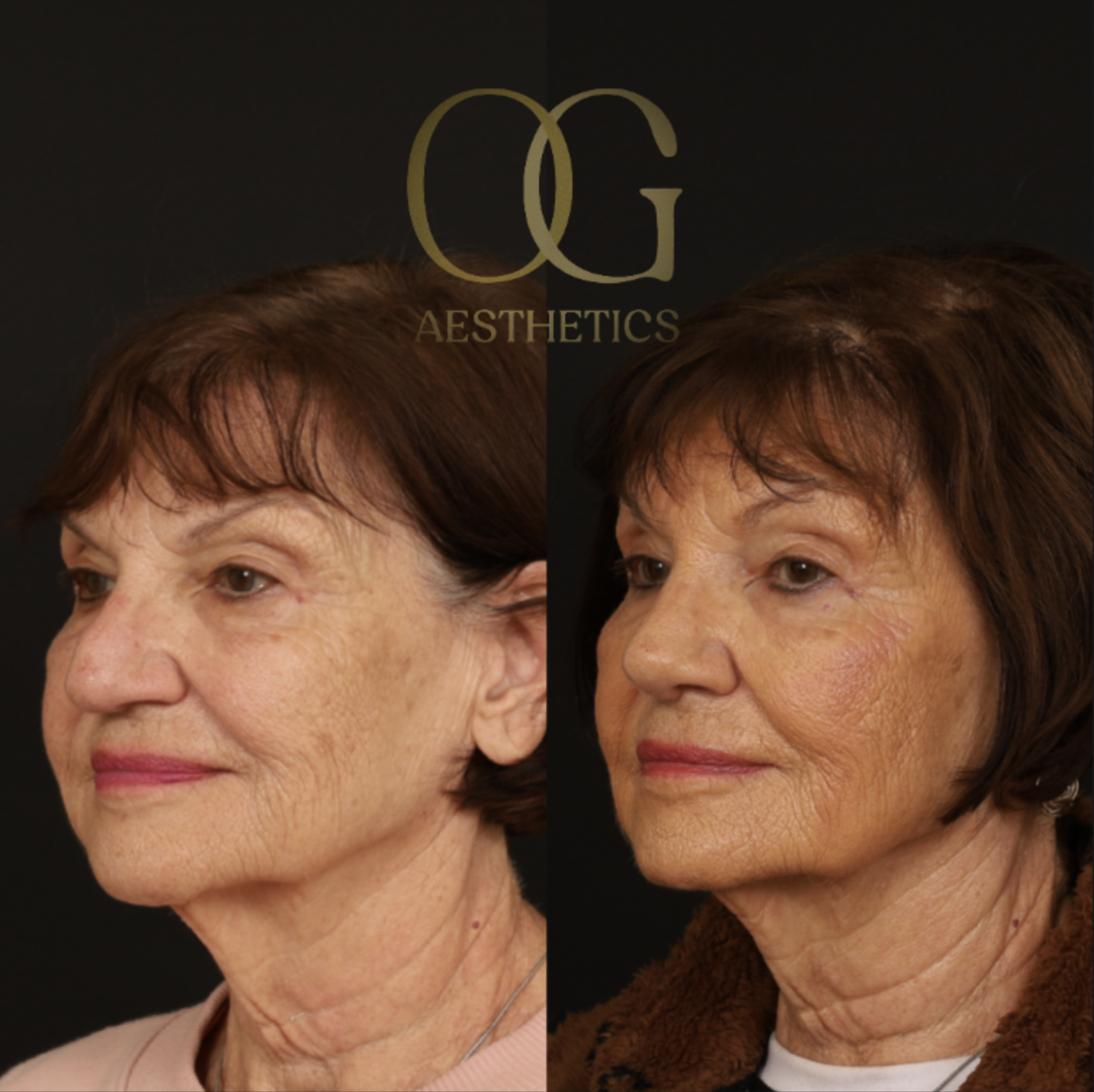 Rhinoplasty Before & After Gallery - Patient 882611 - Image 4