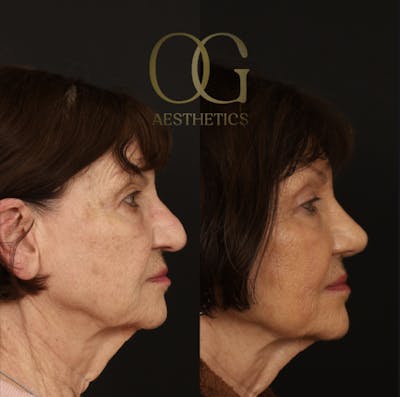 Rhinoplasty Before & After Gallery - Patient 882611 - Image 1