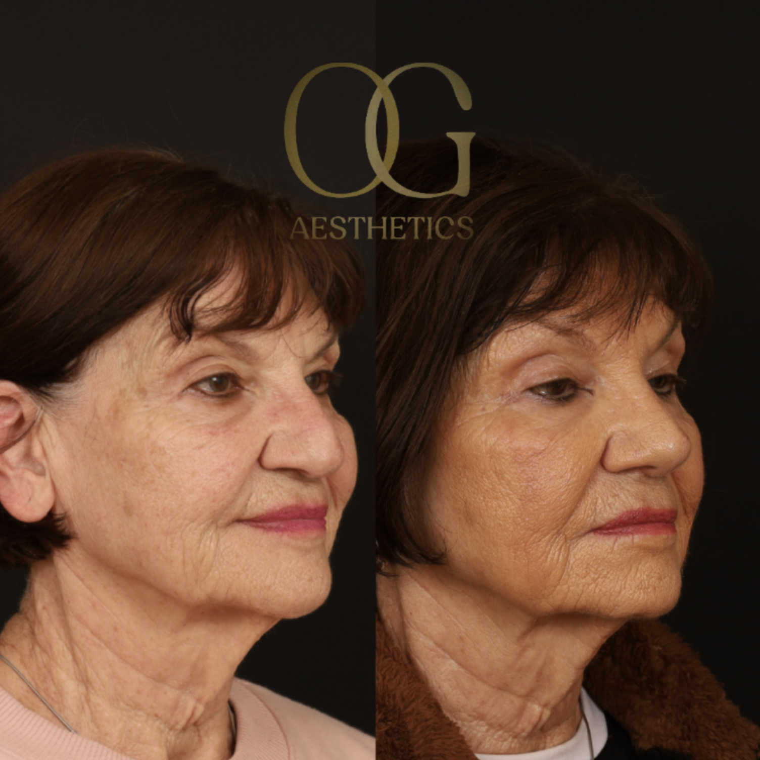 Rhinoplasty Before & After Gallery - Patient 882611 - Image 2