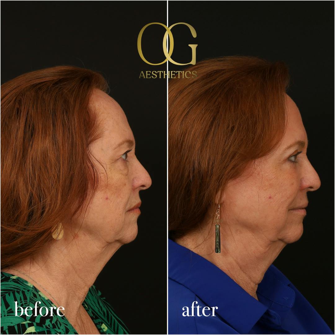 Blepharoplasty Before & After Gallery - Patient 298792 - Image 7
