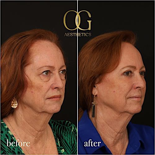Blepharoplasty Before & After Gallery - Patient 298792 - Image 6