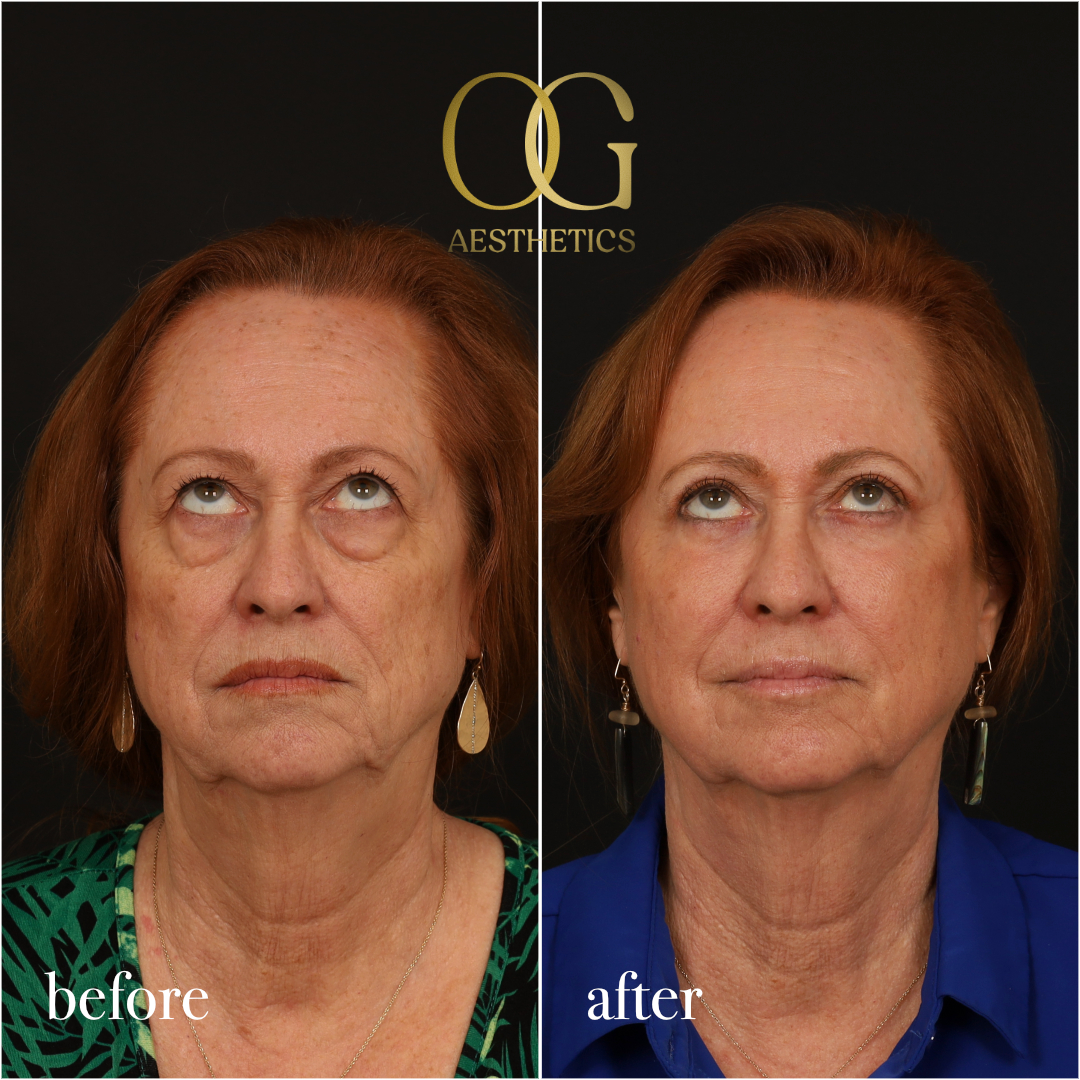 Blepharoplasty Before & After Gallery - Patient 298792 - Image 3